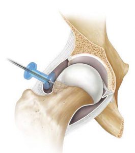 Innovative Solutions for Hip Arthroscopy