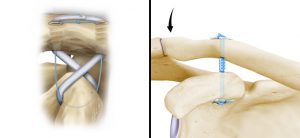 acromioclavicular_joint_separation