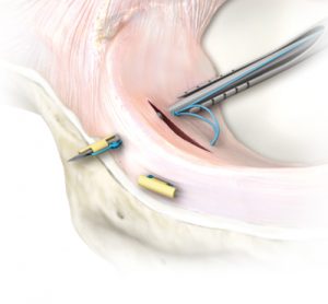 meniscal_repair_0-large2