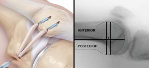 patellofemoral-disease