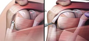 proximal-biceps-pathology