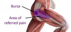 Bursitis