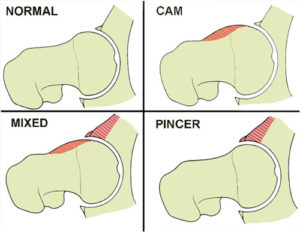 Femoracetabular Impingement