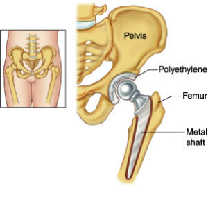 Total hip replacement