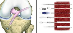acl-tear